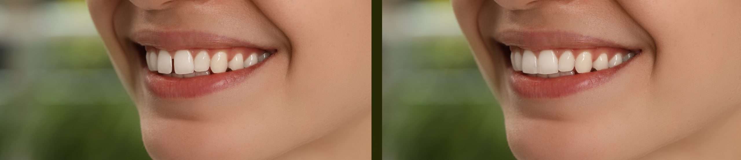 teeth whitening 2