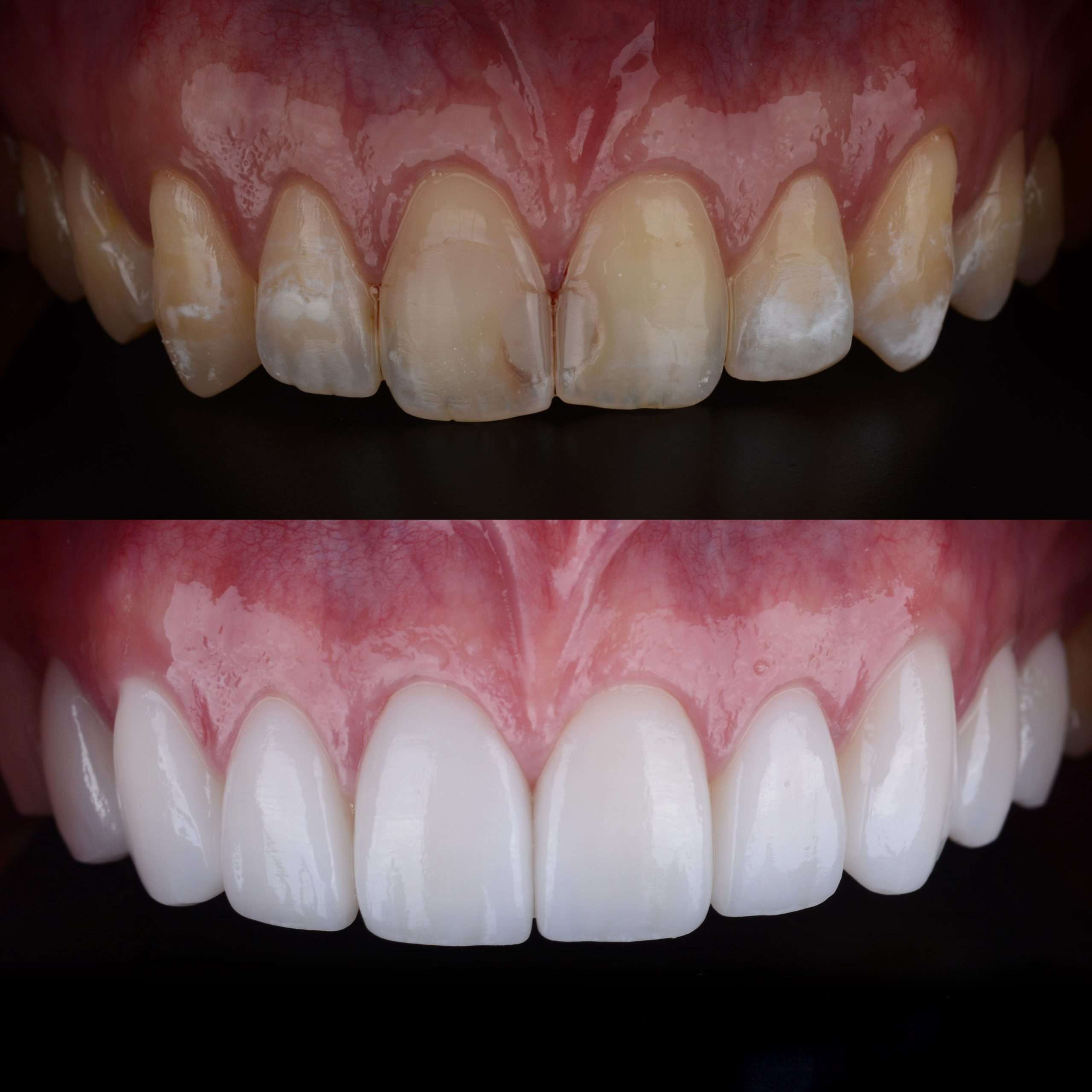 teeth whitening 2