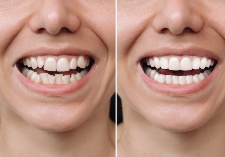 teeth whitening 2